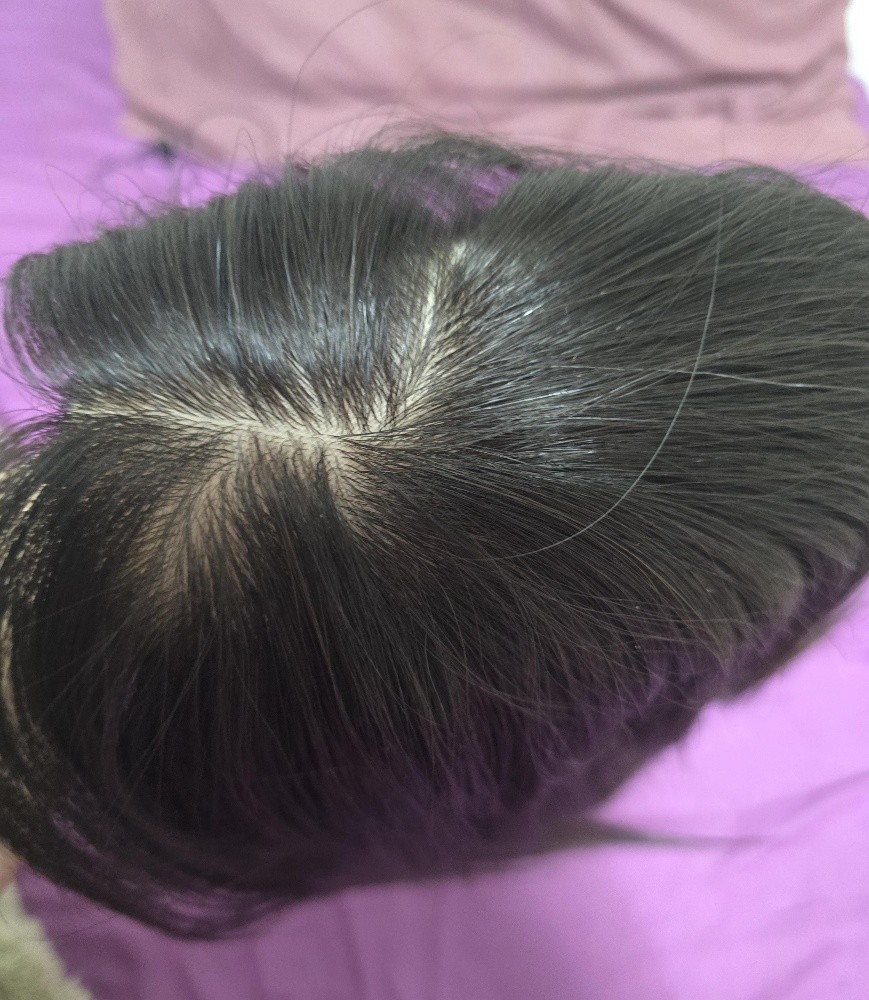 prothèse capillaire - 3